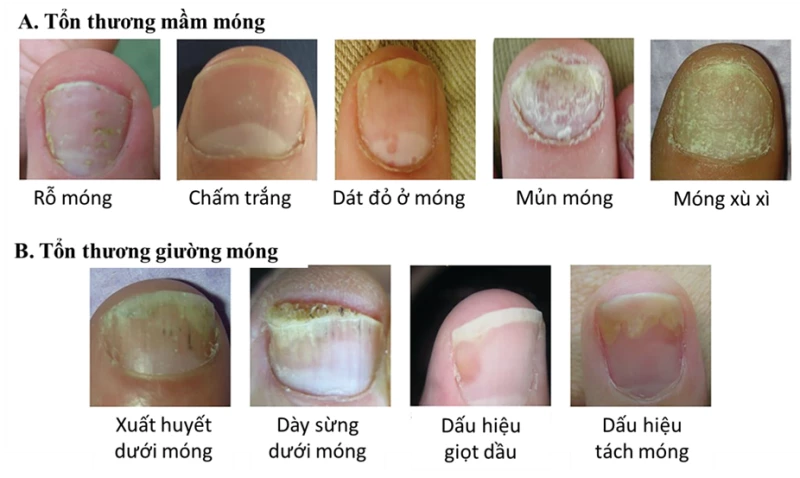 Các hình thái tổn thương móng trong bệnh vảy nến.